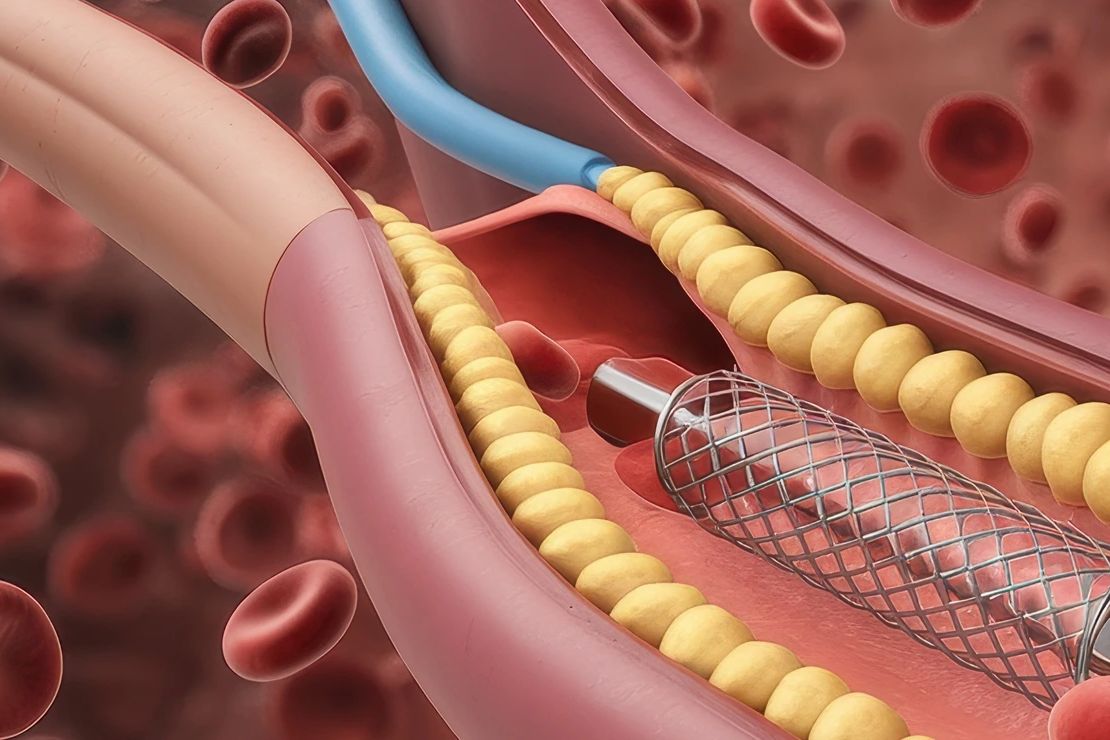 AI-Powered Analysis of Stent Healing