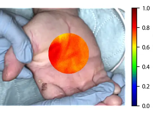 Faster sepsis diagnosis through hyperspectral imaging and AI